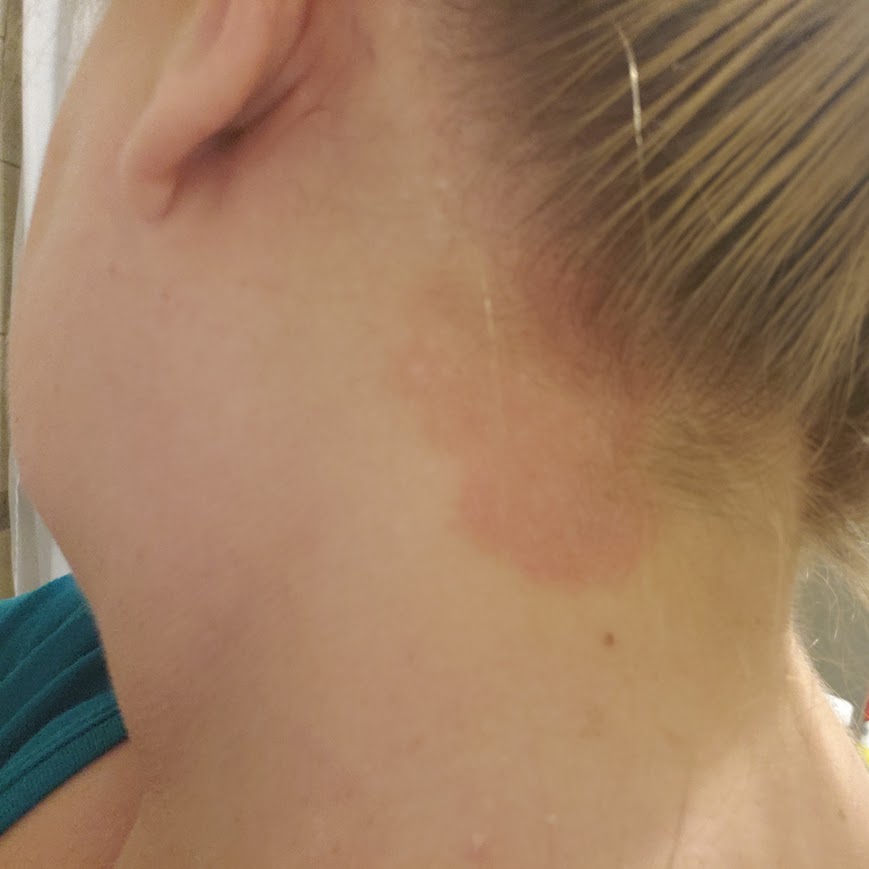 Back of neck with red splotchy spot into the hairline.