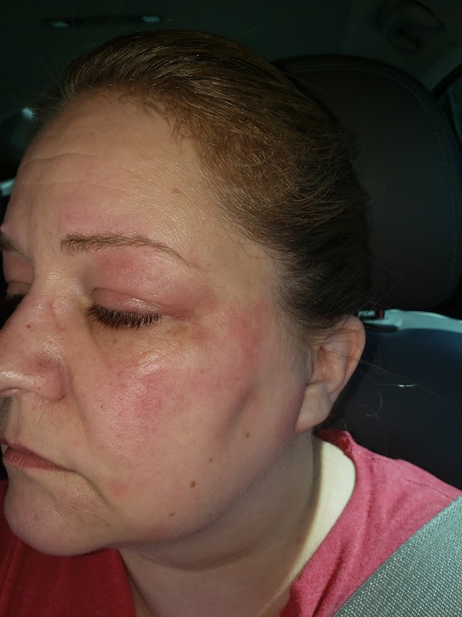 very swollen eyes with skin swolling and puffiness around cheeks