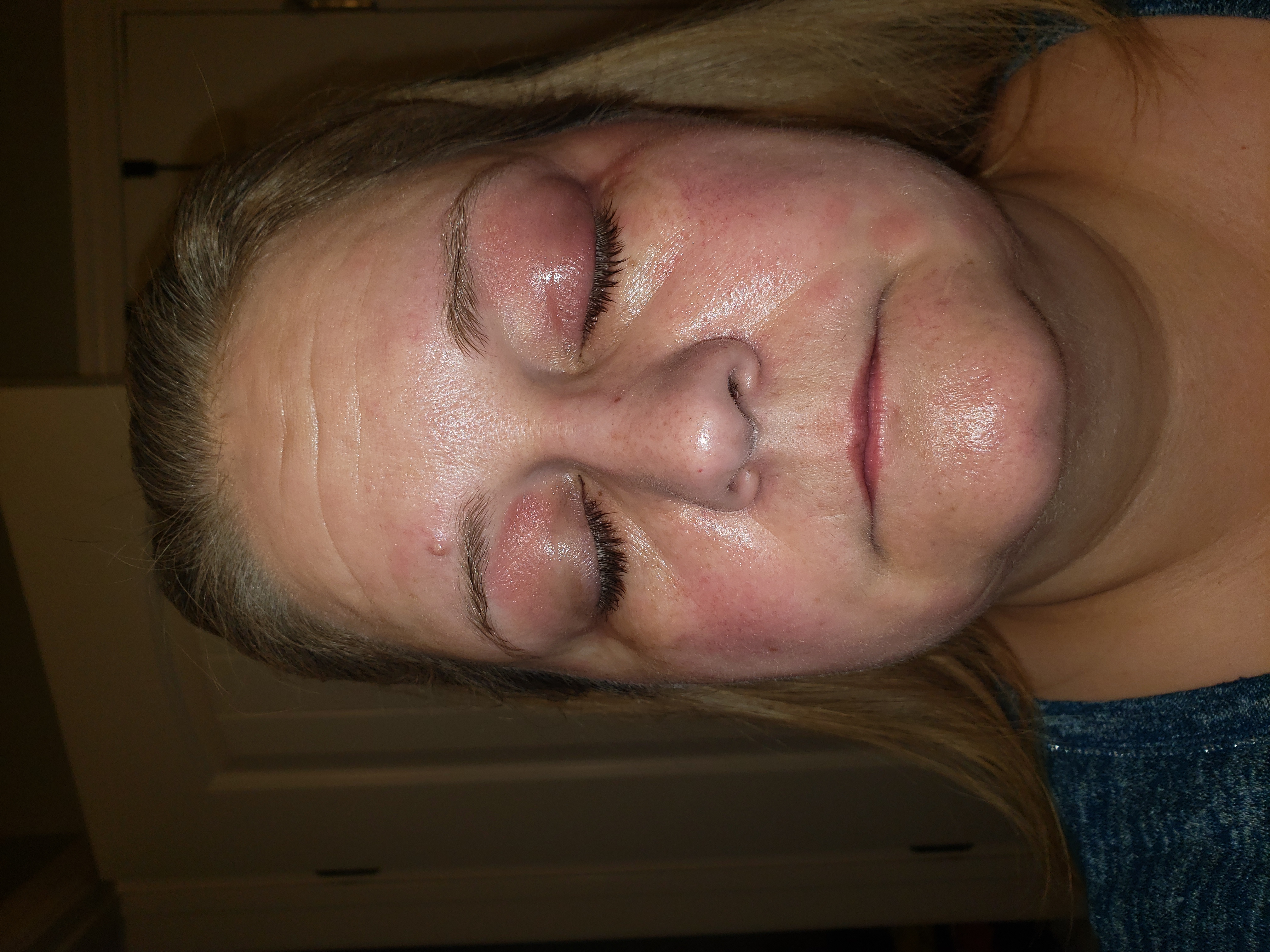 Swollen eyes, looks like a chemical burn, mystery allergy?